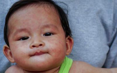 A child's face with a measles rash on it