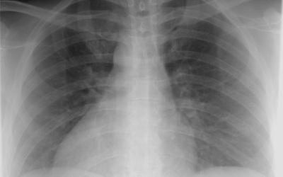 A black and white x-ray of the chest area showing the ribs and lungs